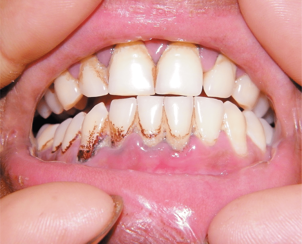 慢性铅中毒的人,牙龈边缘出现的铅线