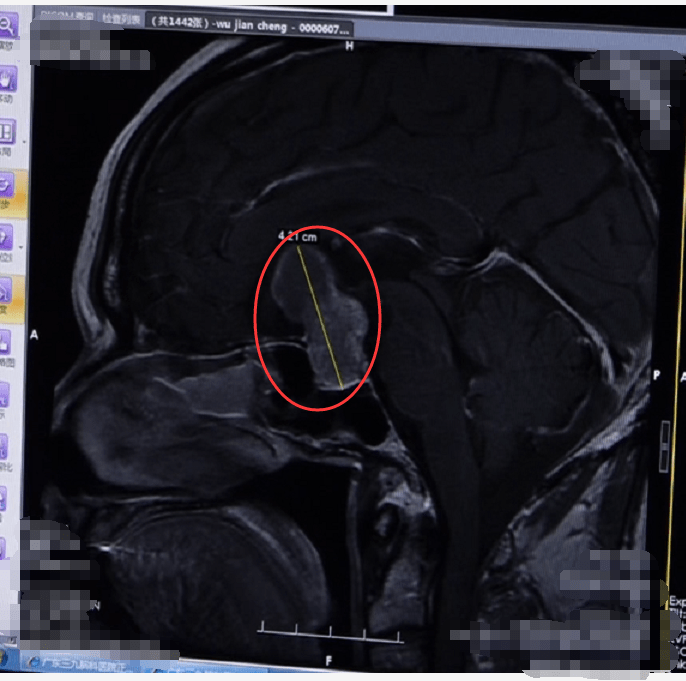 肿瘤|两个月内视力骤降直至失明，竟是颅内肿瘤出血破裂
