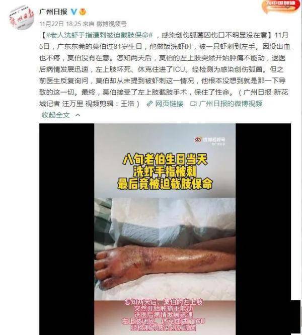 休克|凶险！老人洗虾手指被扎，被迫截肢保命！这种“夺命毒”千万警惕……