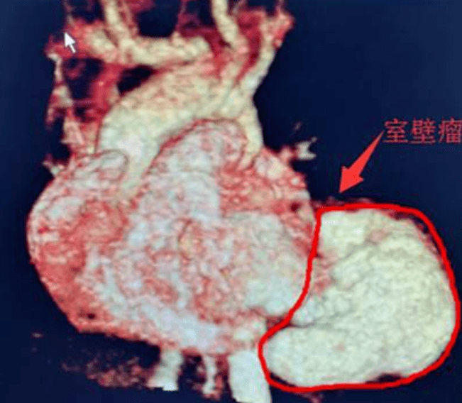 室间隔膜部瘤图片图片