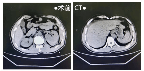 盆腔出血ct图片图片