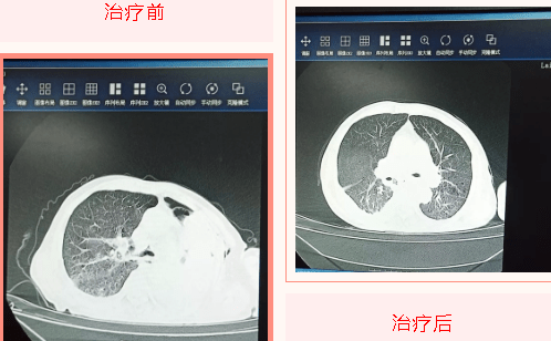 肺泡|莱州市中医医院运用床旁纤维支气管镜治疗重症肺不张患者一例