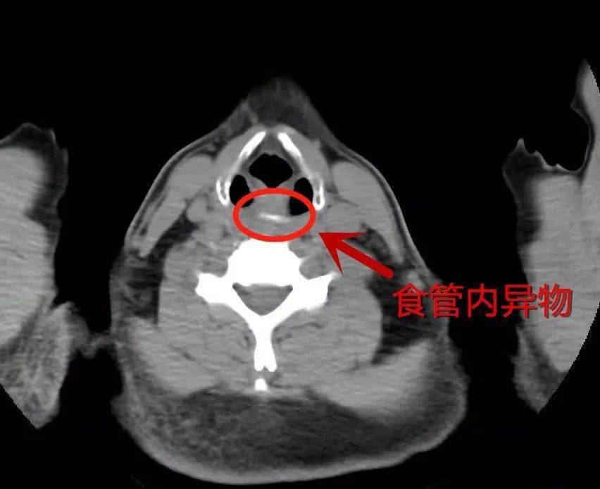 正常人的食道ct图片图片