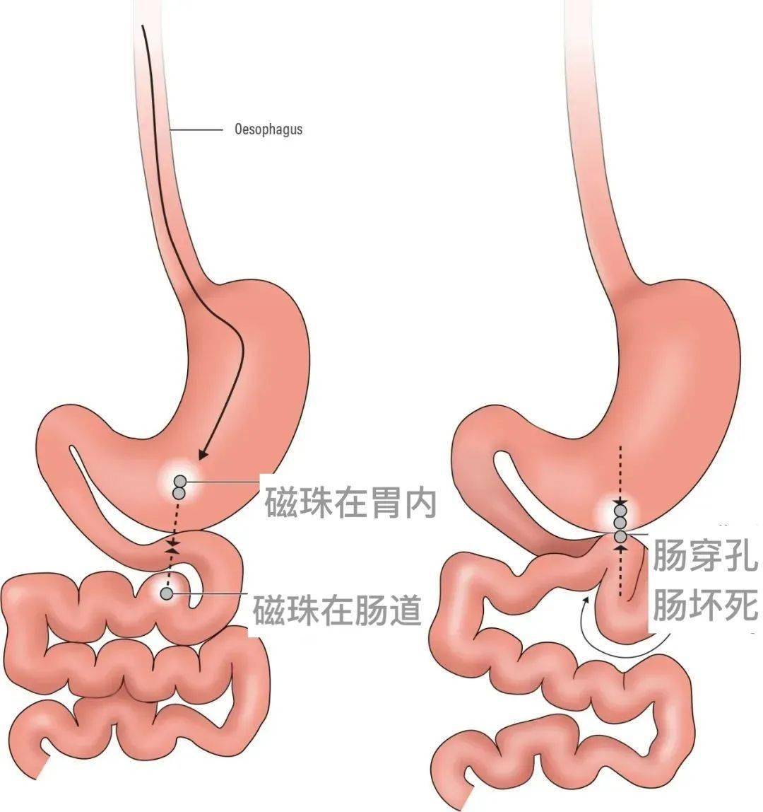 吃了磁力珠多久能倾轧

来_磁力珠吃了后要拍片吗（吃了磁力珠多长时间有反应）
