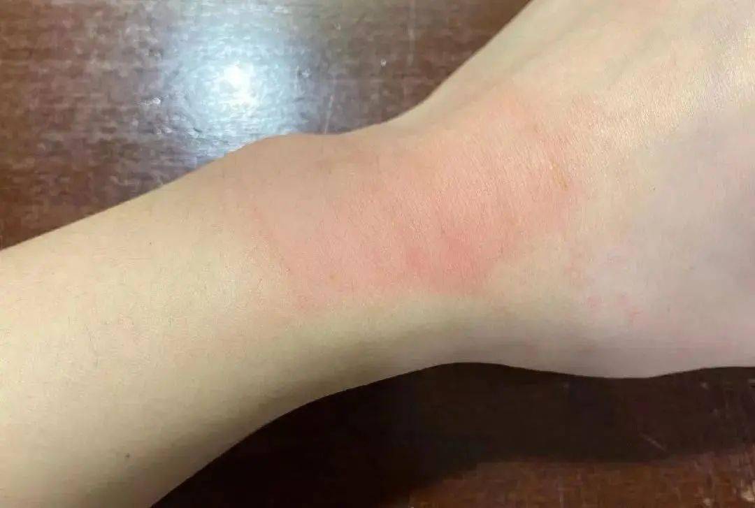 错!膏药不是这么用的!_皮肤_效果_部位