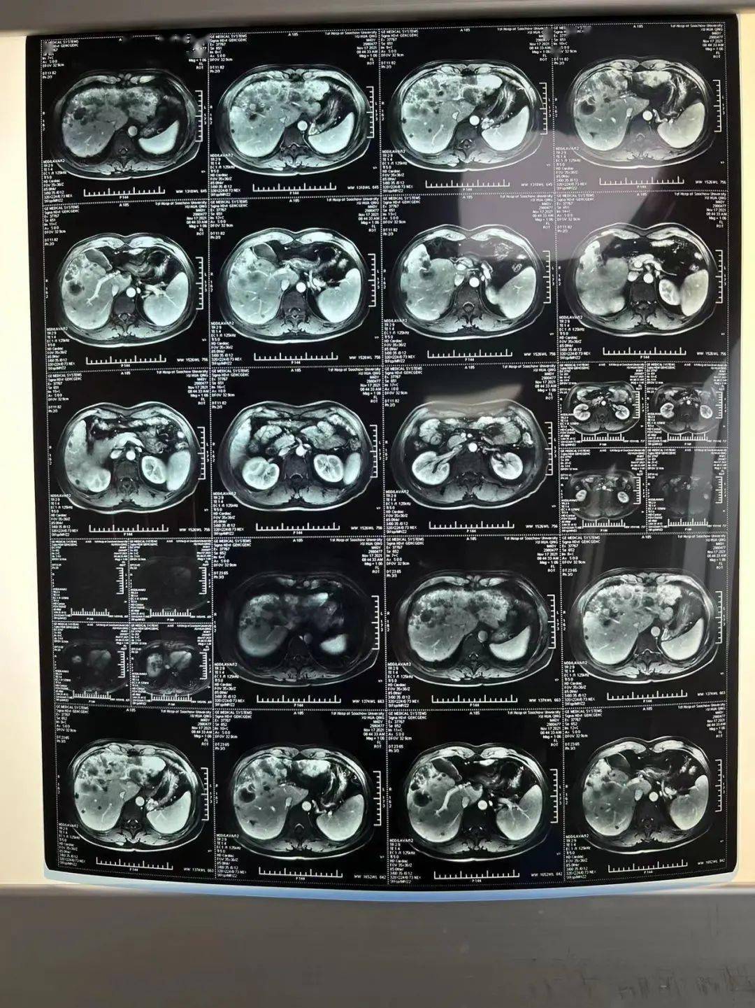 胃部肿瘤检查报告图片图片