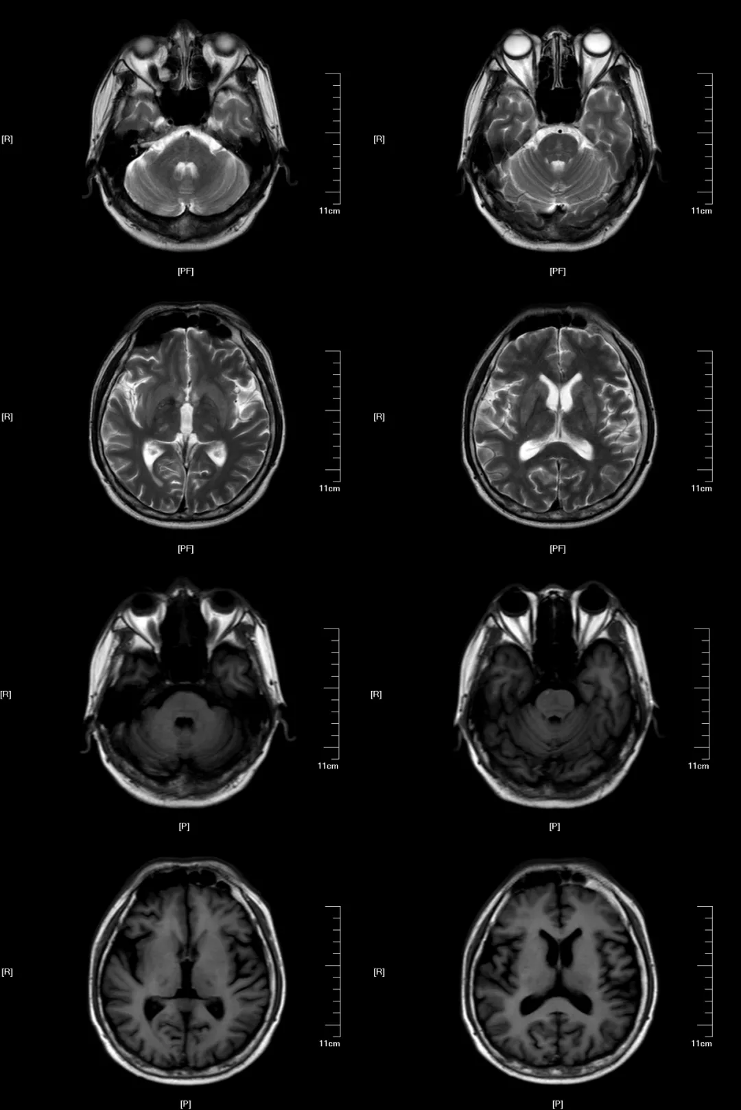 桥脑和桥外渗透性脱髓鞘疾病及其影像解析