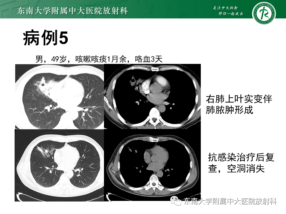 支气管囊肿ct表现图片图片