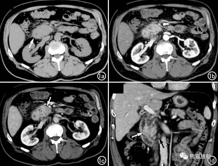 实质|沟槽区胰腺炎丨临床及影像表现