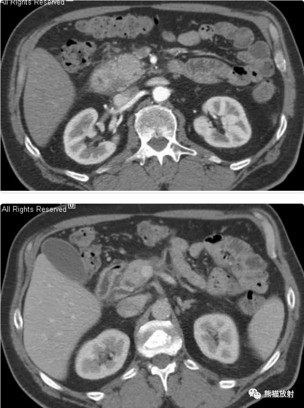 实质|沟槽区胰腺炎丨临床及影像表现