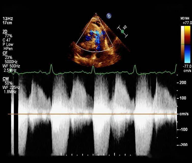 圖 1 收縮期右室流出道內可探及高速血流,最高流速約 390cm/s ,估測壓