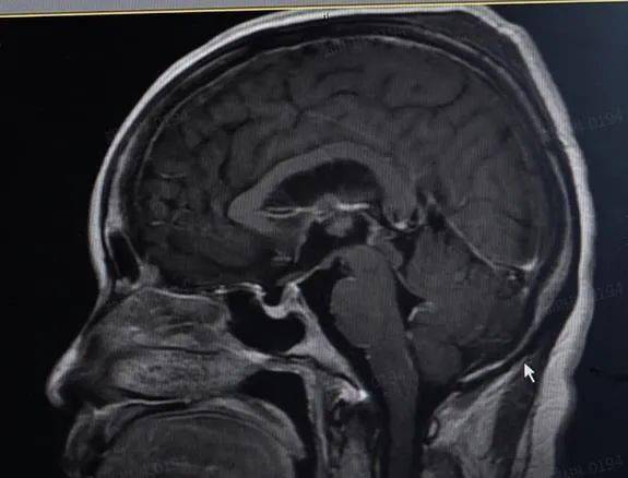 食物|疑因吃了打包放冰箱的食物，广州女子高烧不退险丧命