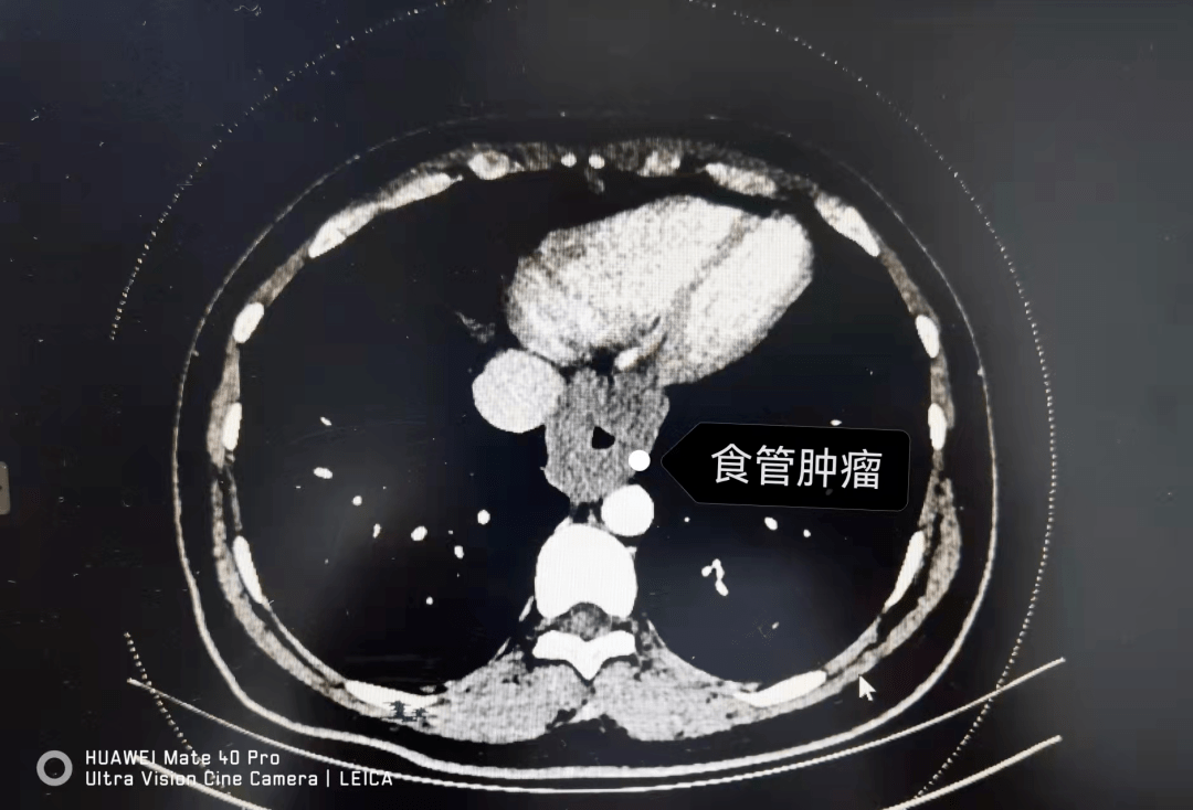 當時懷疑是惡性腫瘤,後來又在另一家醫院檢查胃鏡,結果沒想到的是