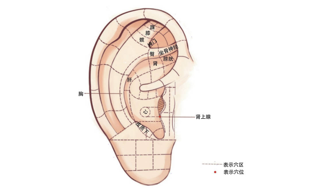 耳穴疗法——坐骨神经痛_进行_皮质_敏感点