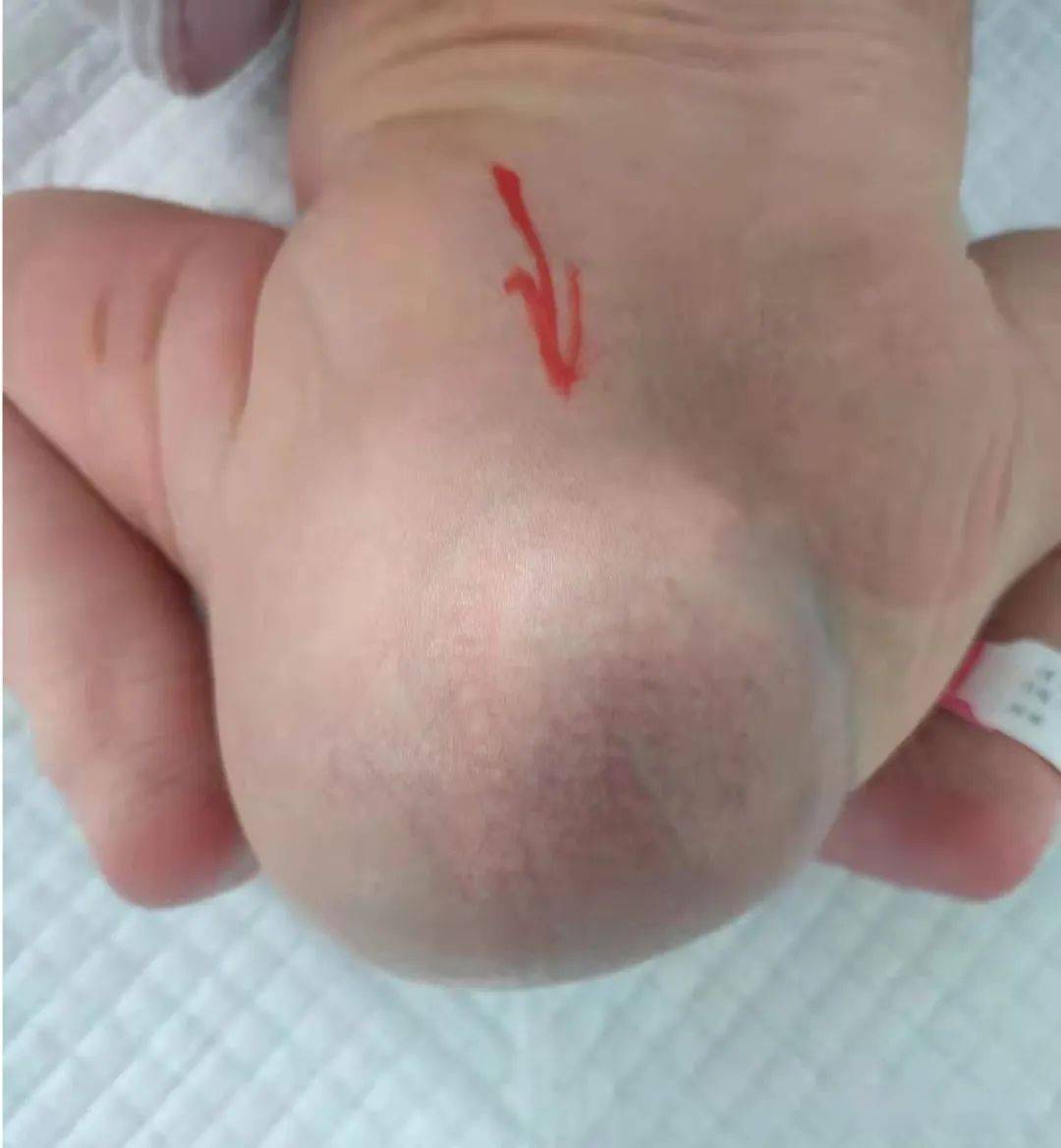 新生儿骶尾部凹陷图片图片