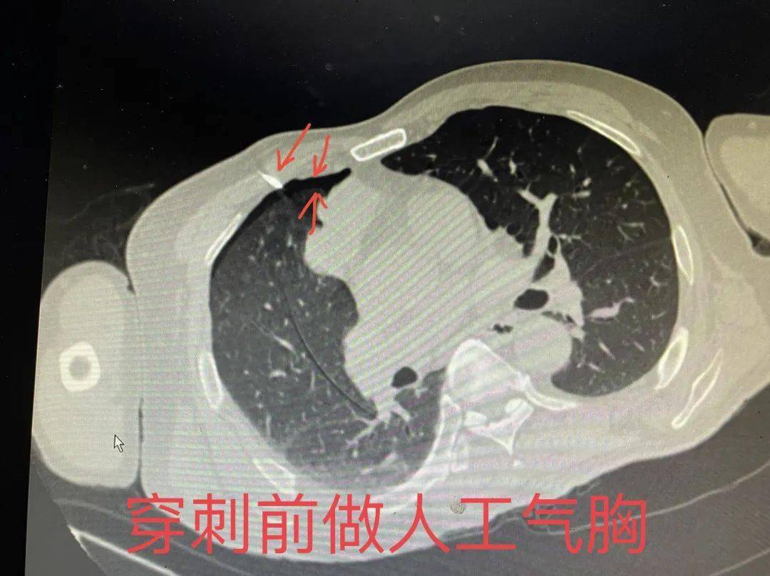 典型病例丨我院成功开展人工气胸后ct引导下纵隔病变穿刺活检术