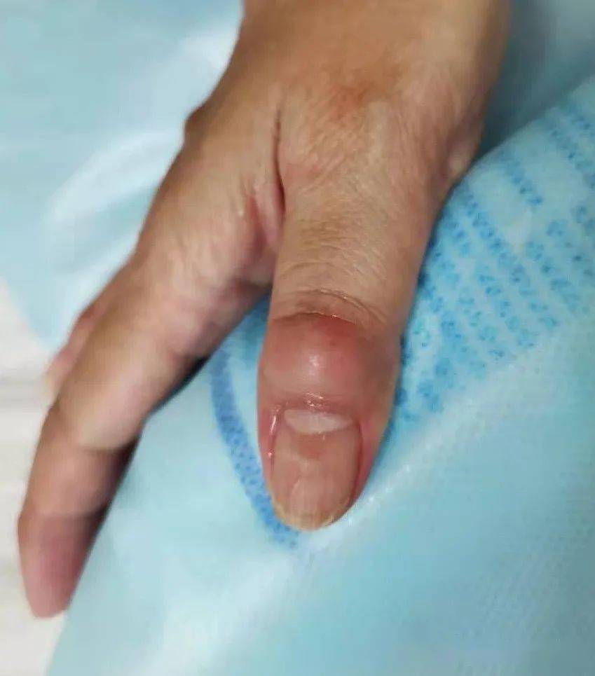 典型病例指端粘液囊肿