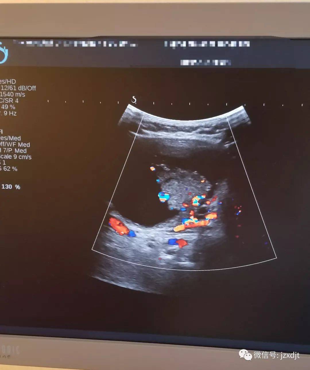 甲状腺内囊实混合回声结节不一定都是良性结节_患者_部分_超声