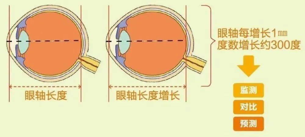 眼轴长度对照表