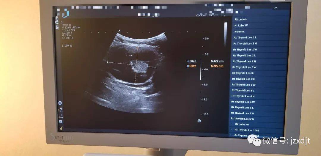 甲状腺内囊实混合回声结节不一定都是良性结节_患者_部分_超声