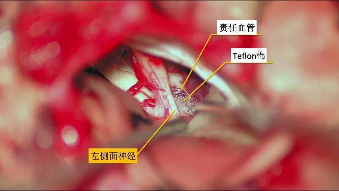 面神经减压手术图片