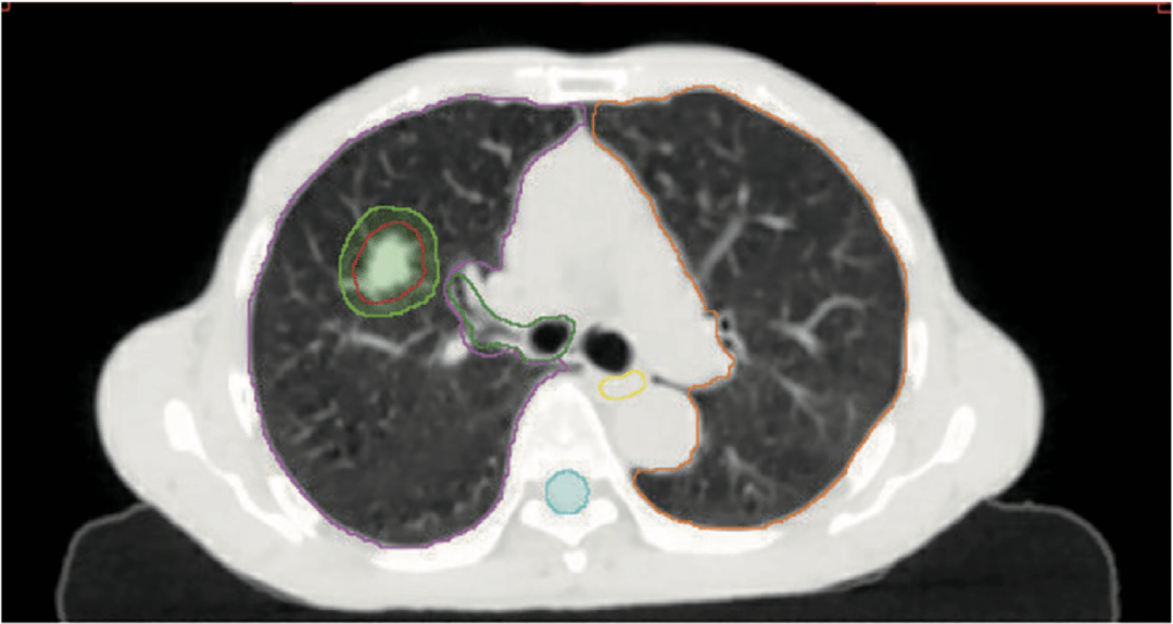 肺癌病例报告模板图片