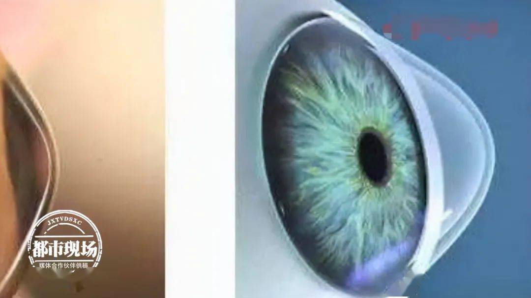 彭凯俊|没事爱揉眼睛，13岁男孩把眼角膜揉破了