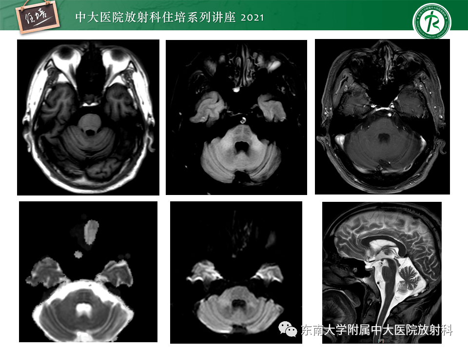 桥臂解剖MRI图片