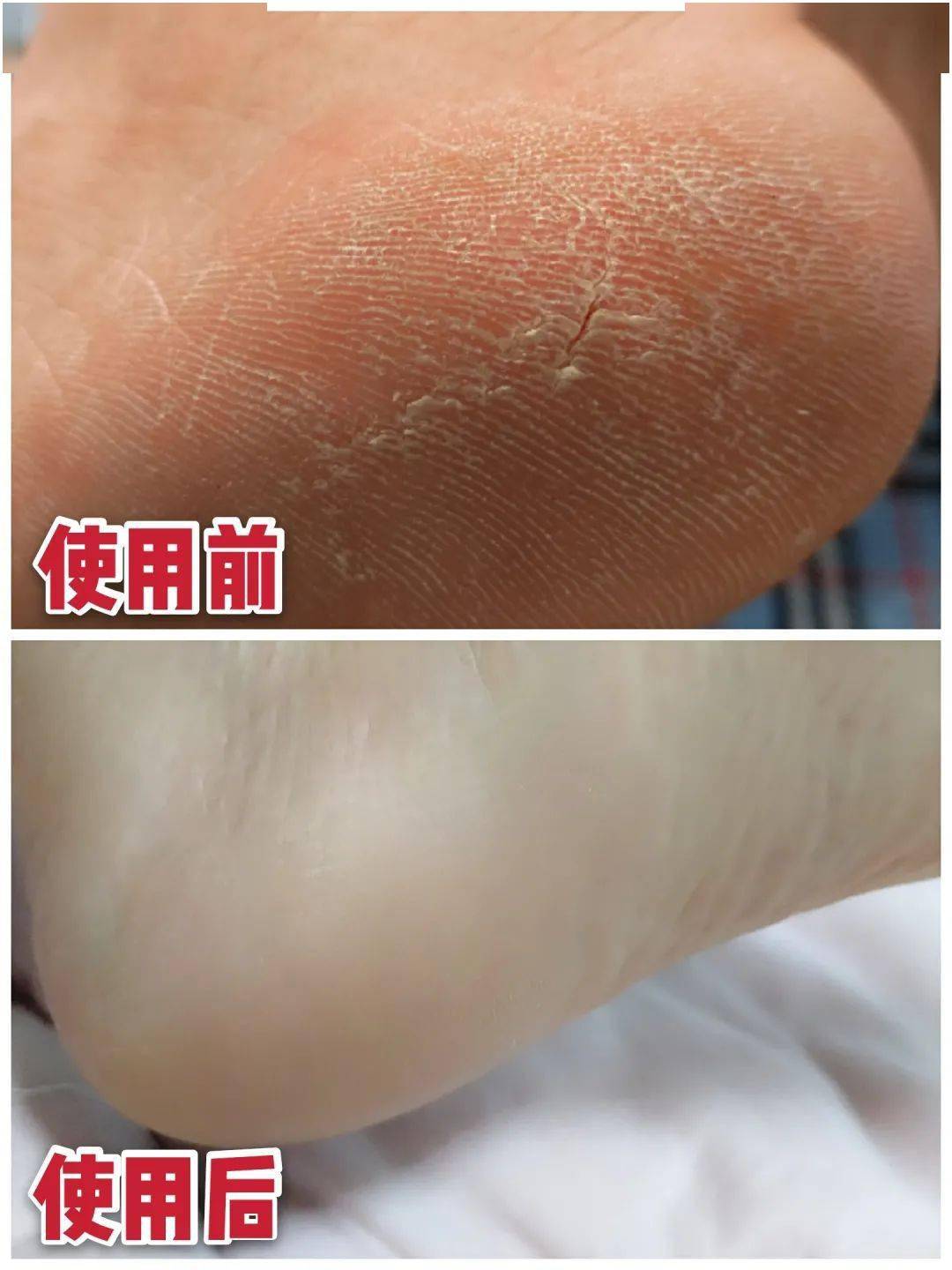 草本植物脚跟开裂、老茧、死皮……又疼又丑！用它一抹，双脚嫩滑，实测惊呆了！