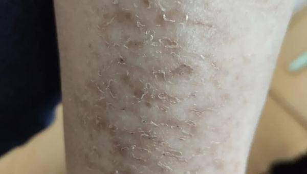 习惯|干燥脱屑，像“鱼鳞”！杭州大伯每晚痒得睡不着！是因为......