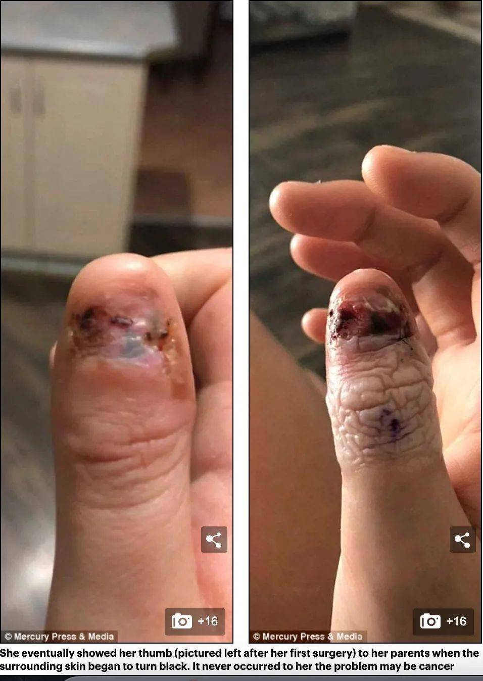 警戒澳洲姑娘酷爱咬指甲结果咬出癌症被迫截肢这事别干了