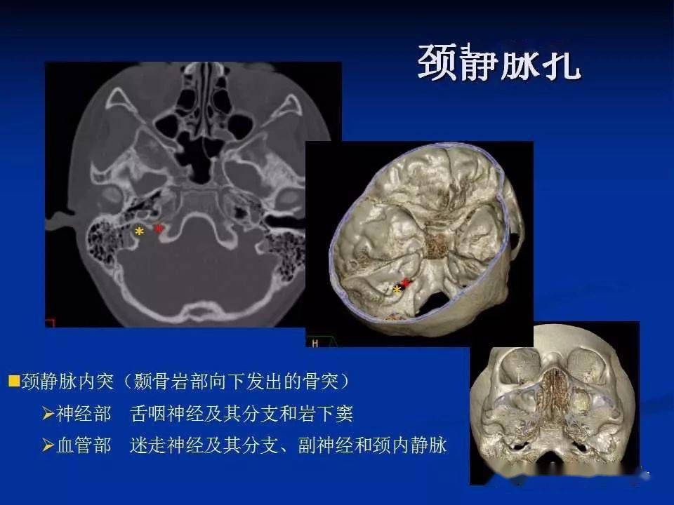 實用,詳細的顱底各孔道影像解剖!_結構_動脈_神經