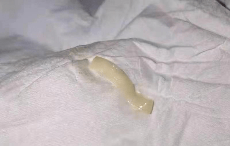 厦门|可怕！只因冬天“懒癌”犯了，一大学生排出一条活虫！厦门人注意！这东西少吃！