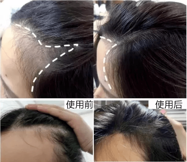头皮头发总掉竟是「发根」缺了它！简单一招，5天生新发！发量重回18岁