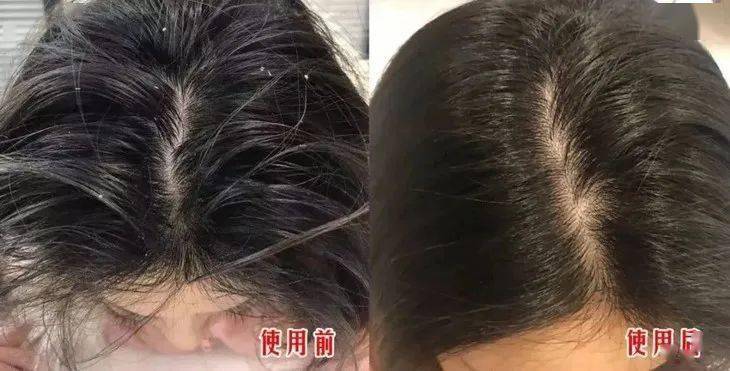 头皮头发总掉竟是「发根」缺了它！简单一招，5天生新发！发量重回18岁