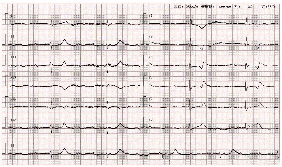 房性心律心电图特点图片