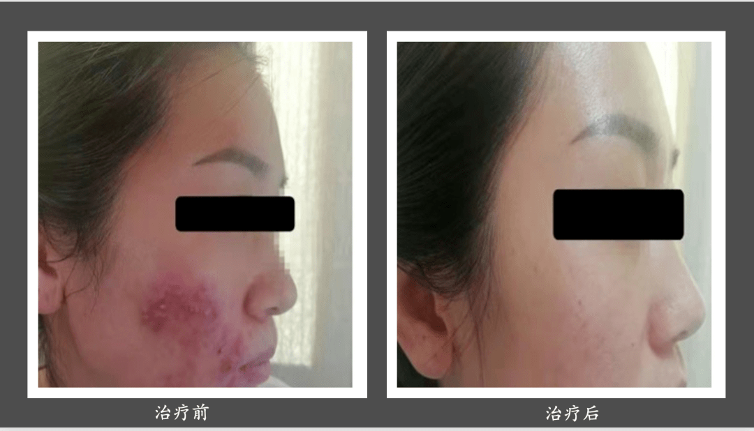 面部痤疮 治疗方法图片