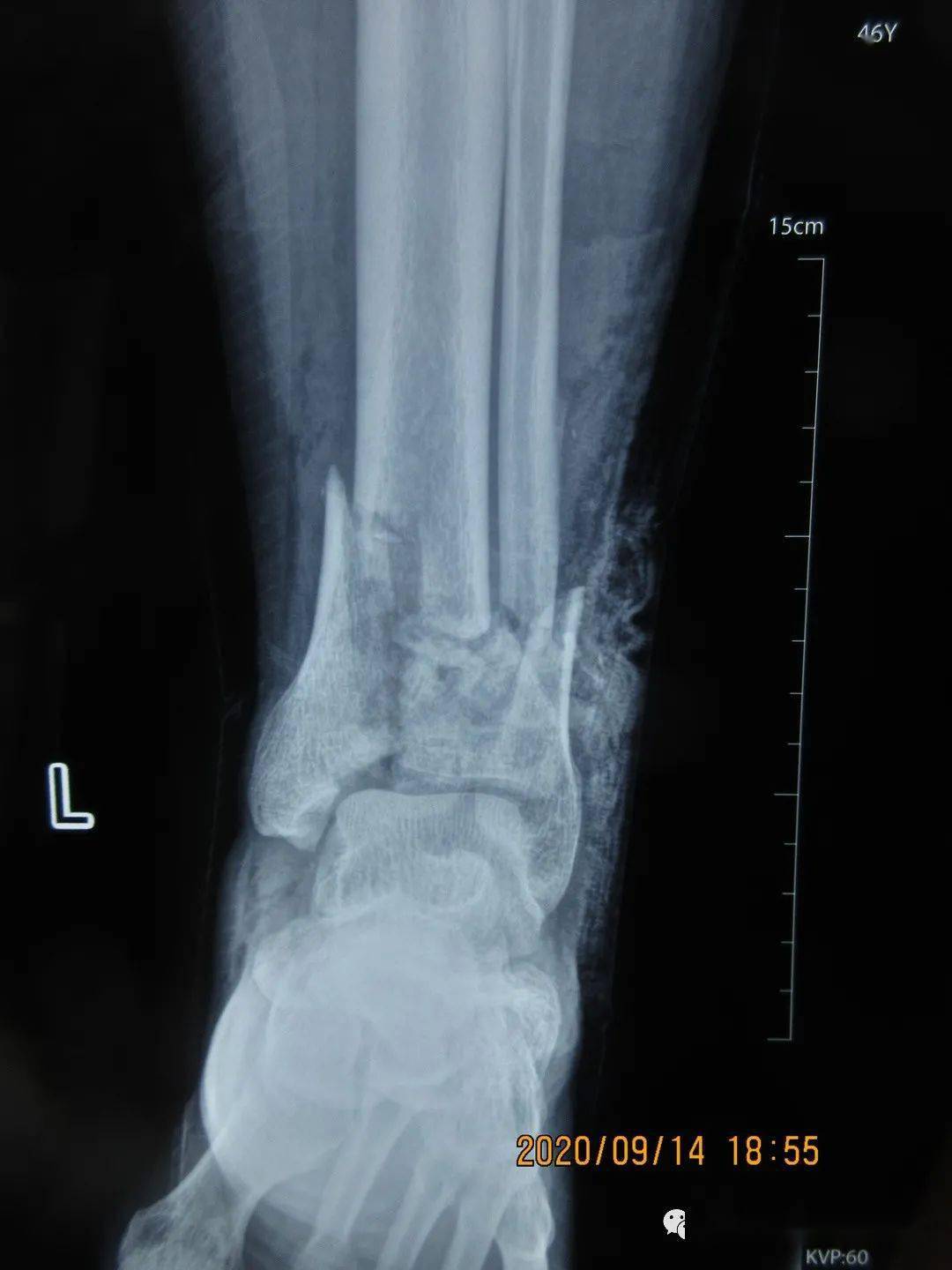 腿骨折病例图片