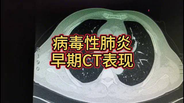 早期bingdu性肺炎ct影像学表现病毒性肺炎磨玻璃密度影