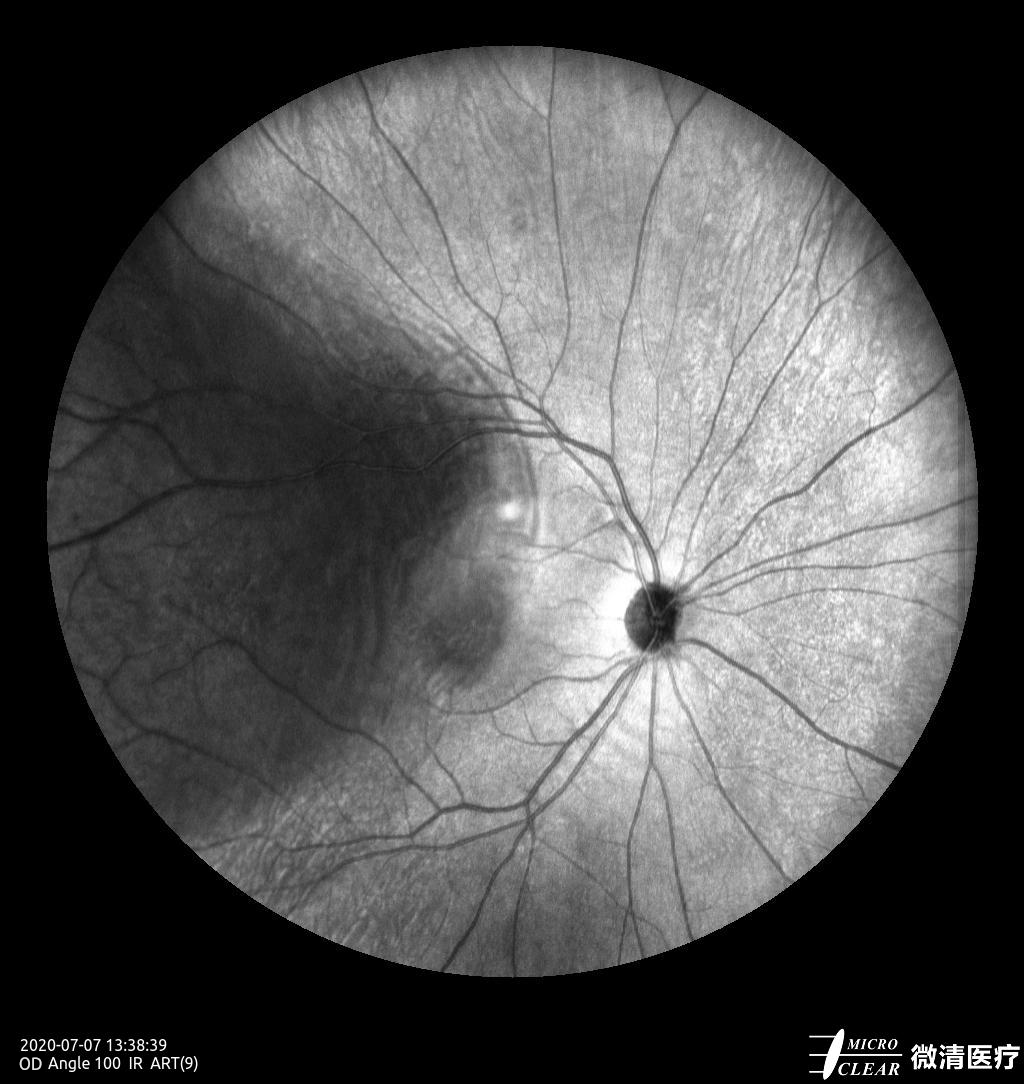 视网膜脱落B超图片