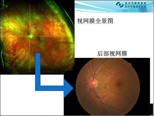 如何理解眼底照片