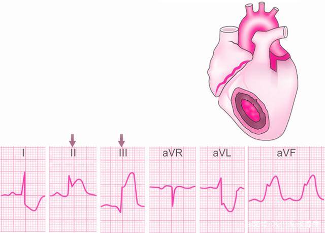 其实在临床的心电图报告之中非常的常见,许多的人也都会拿着心电图问