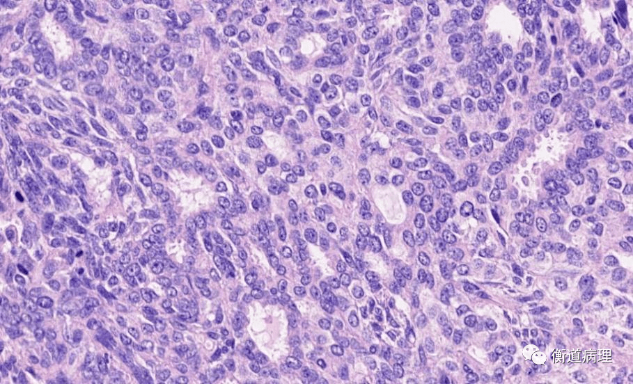 滑膜肉瘤病理图片