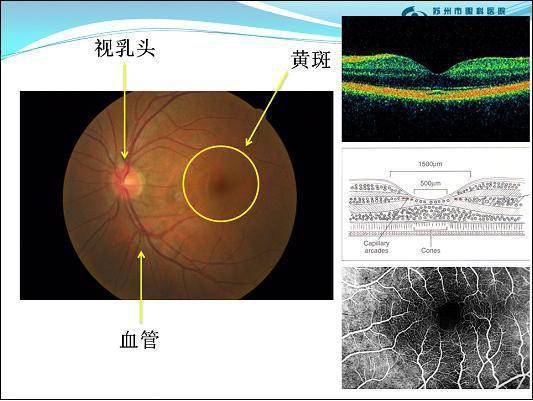 如何理解眼底照片