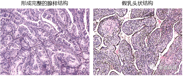 滑膜肉瘤synovialsarcoma如何诊断