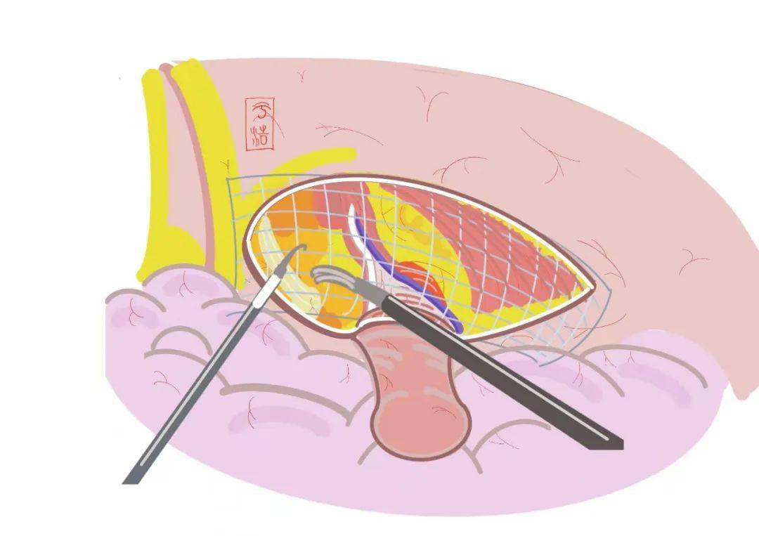 腹腔镜疝气手术太抽象这篇图文帮你理解记忆