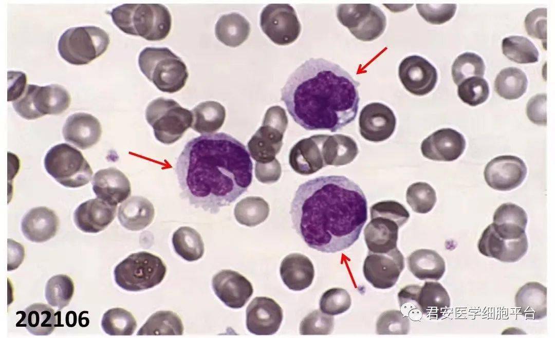 外周血涂片 瑞氏-吉姆萨染色 1000x202106卡波氏环(cabot ring)点击