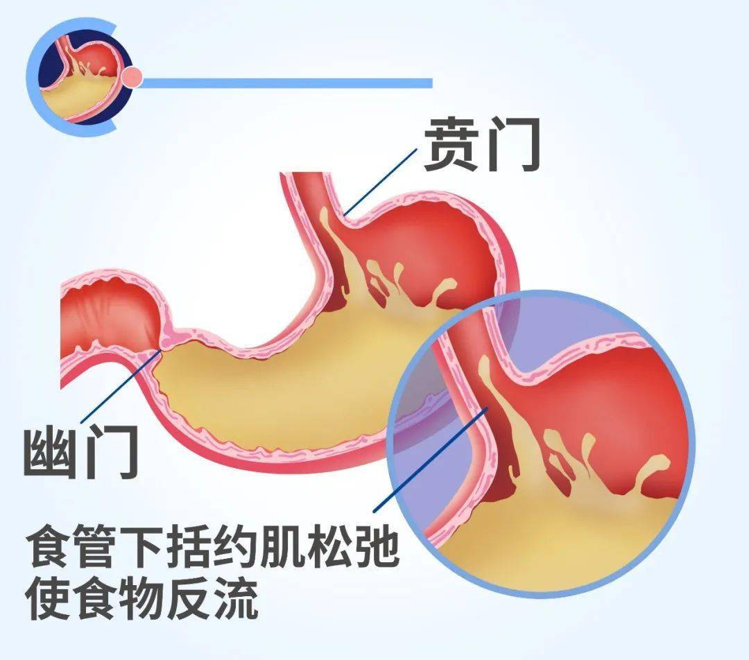在这一过程中引起的一系列相应症状,就叫胃食管反流病
