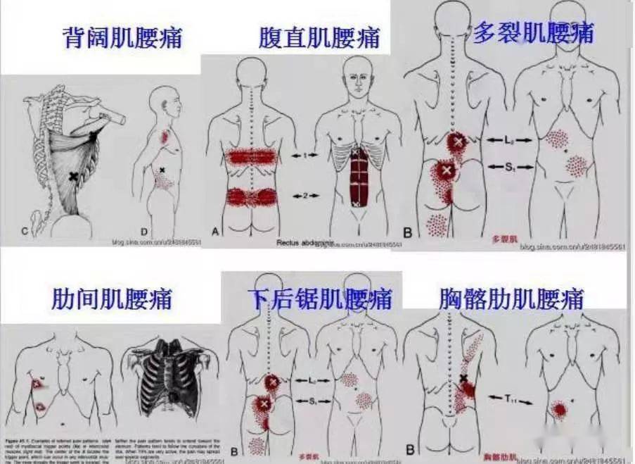 肌筋膜全身160个疼痛触发点