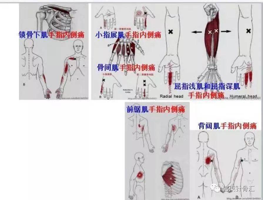 肌筋膜全身160个疼痛触发点